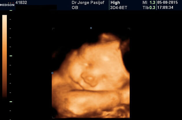 nota Preeclampsia