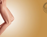 Varices en las piernas