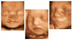 Para qué hacerme un scan fetal detallado ?