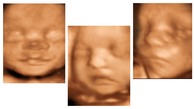 Para qué hacerme un scan fetal detallado ?