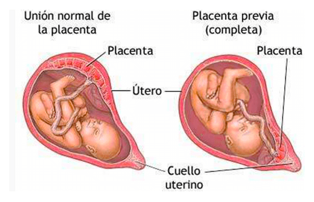 Cuadro Placenta Previa